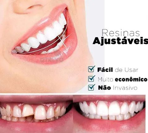 FACETAS DENTÁRIAS NATURAIS REMOVIVEIS